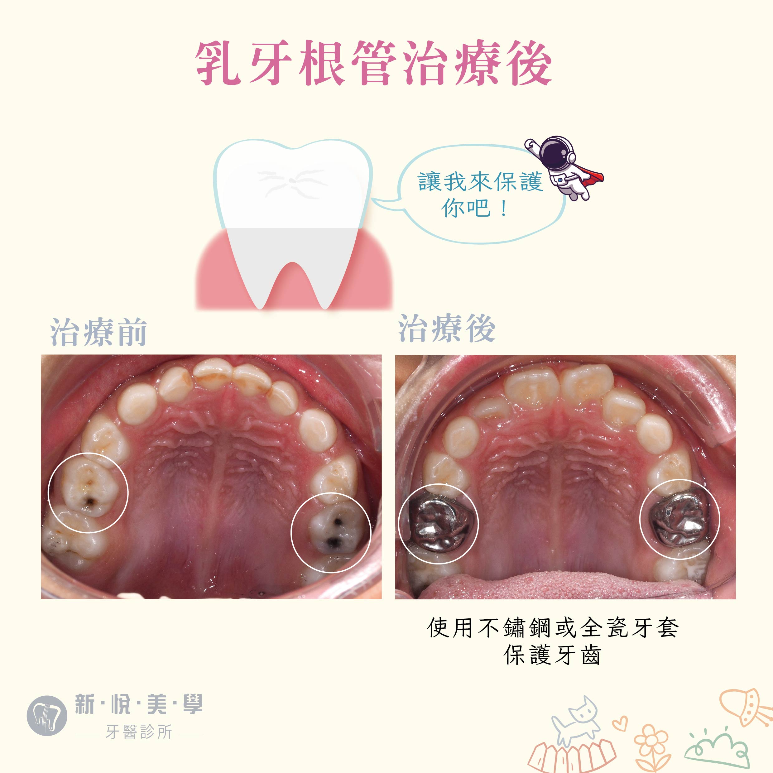 [新悅美學牙醫案例]  我們家寶貝有蛀牙怎麼辦?的第3張圖片